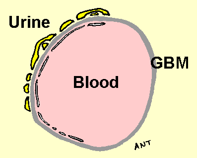 Glomerular Basement Membrane Disorders, Glomerular Basement Membrane Defect